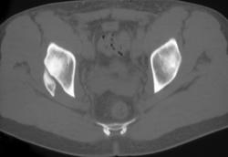 Posterior Acetabular Fracture (healing) - CTisus CT Scan