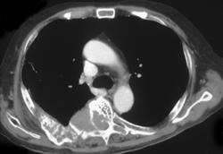 Metastases to Bone (prostate Cancer) - CTisus CT Scan