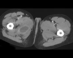 Intramuscular Abscess - CTisus CT Scan