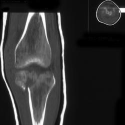 Tibial Plateau Fracture - CTisus CT Scan