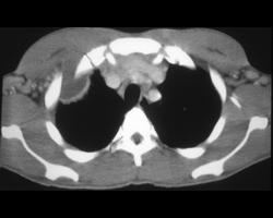 Abscess Involving Chest Wall - CTisus CT Scan