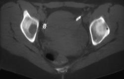 Breast Cancer Metastatic to Bone - CTisus CT Scan