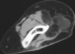 Liposarcoma - CTisus CT Scan