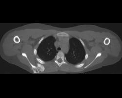 Osteochondroma Scapula - CTisus CT Scan