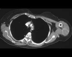 Metastases to Muscle From A Renal Carcinoma - CTisus CT Scan