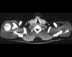 Lymphoma of the Scapula - CTisus CT Scan