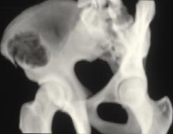 Aneurysmal Bone Cyst (ABC) With Fracture - CTisus CT Scan