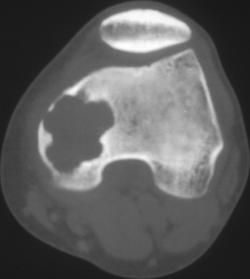 Chondromyxoid Fibroma (CMF) - CTisus CT Scan