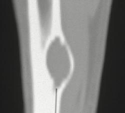 Simple Cyst of Bone - CTisus CT Scan