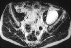 Iliopsoas Abscess - CTisus CT Scan