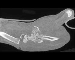 Osteomyelitis Wrist - CTisus CT Scan