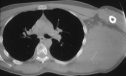 Ewing of the Scapula - CTisus CT Scan