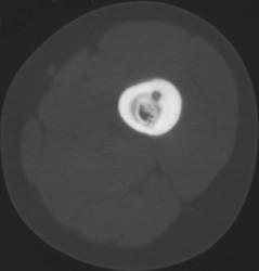 Osteoid Osteoma - CTisus CT Scan