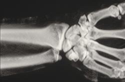 Triquetrum Fracture - CTisus CT Scan