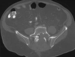 Neurofibromatosis - CTisus CT Scan