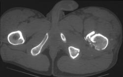 Femur Fracture - CTisus CT Scan