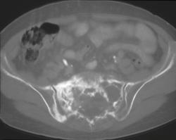 Radiation Osteitis Sacrum - CTisus CT Scan