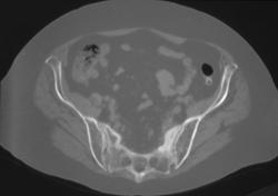 Stress Fracture Sacrum - CTisus CT Scan