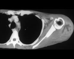 Intramuscular Abscess - CTisus CT Scan