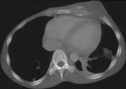 Chest Wall Abscess - CTisus CT Scan