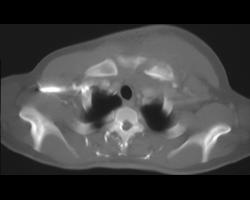 Osteomyelitis Clavicular Head - CTisus CT Scan