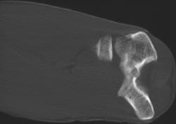 Osteoid Osteoma - CTisus CT Scan