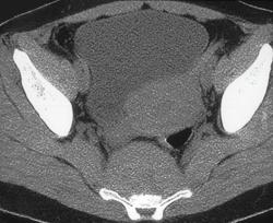 Chordoma - CTisus CT Scan