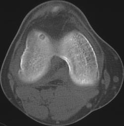 Osteoid Osteoma - CTisus CT Scan