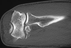 Ulna Fracture - CTisus CT Scan