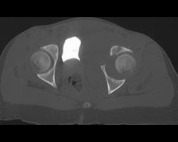 Acetabular Fracture With Pelvic Hematoma - CTisus CT Scan