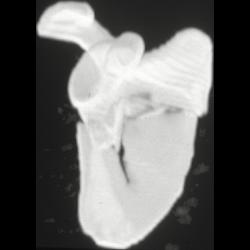 Scapular Fracture - CTisus CT Scan