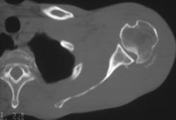 Humerus Fracture With Dislocation - CTisus CT Scan