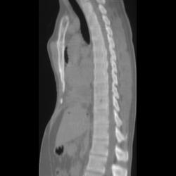 Jeune Syndrome - CTisus CT Scan