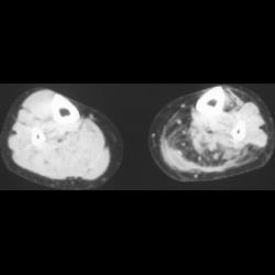 Old Gastrocnemius Tear - CTisus CT Scan