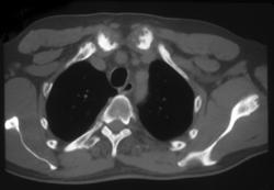 Anklyosing Spondylitis - CTisus CT Scan