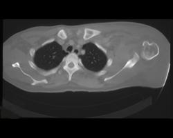 Osteomyelitis With Intramuscular Abscess (salmonella) - CTisus CT Scan