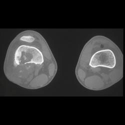 Osteosarcoma - CTisus CT Scan