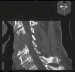 Renal Cell Cancer Metastatic to C Spine - CTisus CT Scan