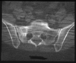 Stress Fracture Sacrum - CTisus CT Scan