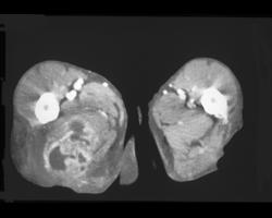 Intramuscular Abscess - CTisus CT Scan