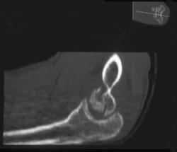 Humerus Fracture - CTisus CT Scan