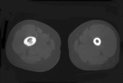 Osteoid Osteoma - CTisus CT Scan