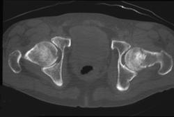 Femur Fracture - CTisus CT Scan