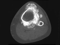 Parosteal Osteosarcoma - CTisus CT Scan