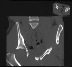 Hip Dislocation - CTisus CT Scan