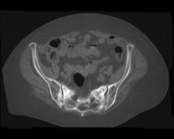 Stress Fracture - CTisus CT Scan