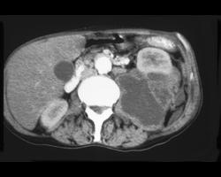 Psoas Abscess (TB) - CTisus CT Scan