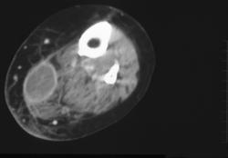 Intramuscular Abscess - CTisus CT Scan