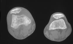 Infected Knee Joint - CTisus CT Scan