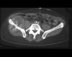 Metastatic Colon Cancer - CTisus CT Scan